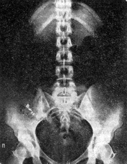 Фиг. 5. Рентгенограмма, на которой виден эндорадиозонд в восходящей ободочной кишке женщины
