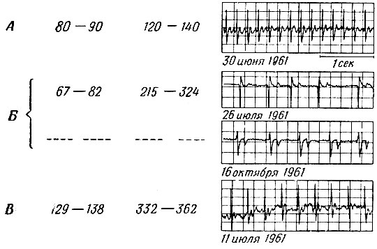 Фиг. 4. ЭКГ и частота сердечных сокращений (число ударов в 1 мин) у трех обитающих в Арктике млекопитающих (А - суслик, Б - песец, В - заяц-беляк), полученные с помощью имплантированных передатчиков. Цифры слева - нижняя граница, цифры справа - верхняя граница